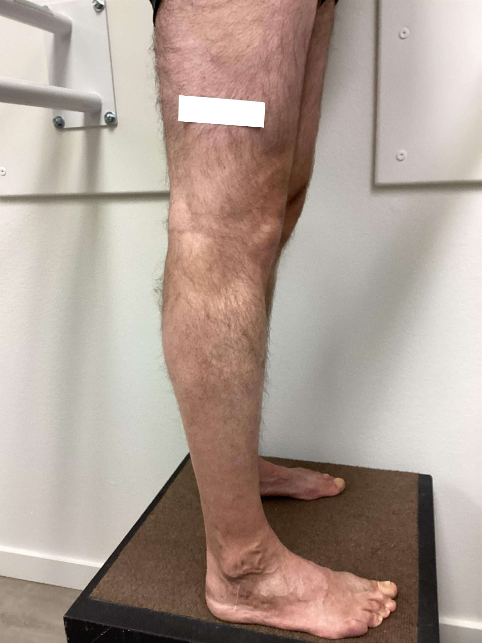 After Image: Varicose Veins - right-side