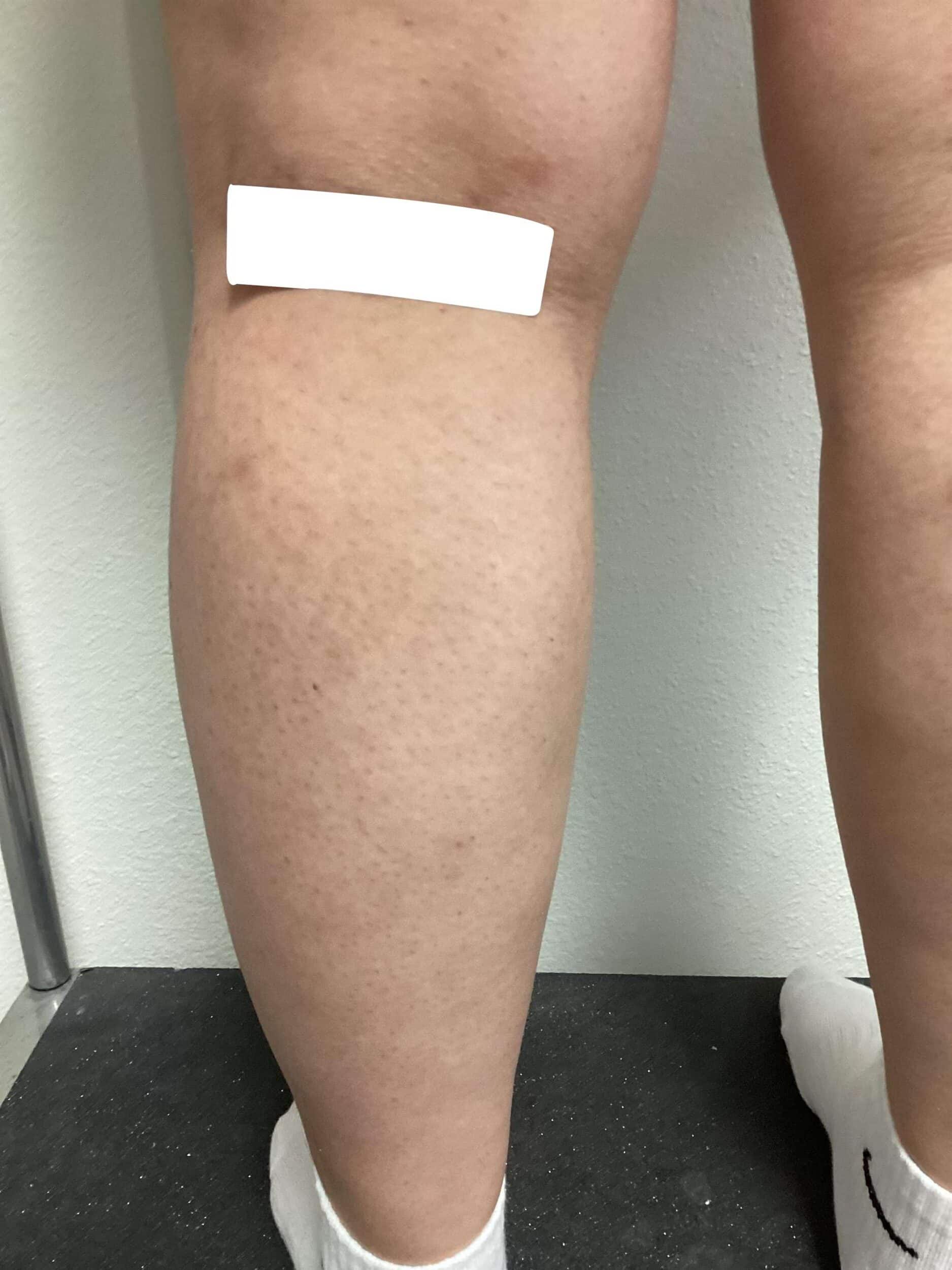 After Image: Spider Veins - left-back-oblique