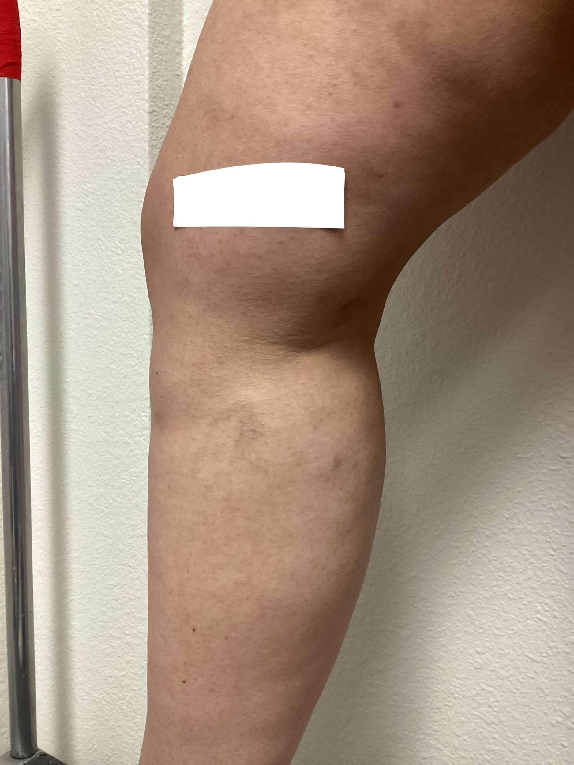 After Image: Spider Veins - front