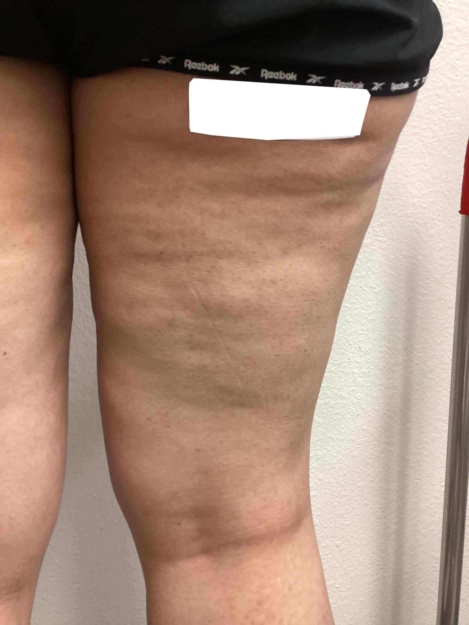 After Image: Spider Veins - back