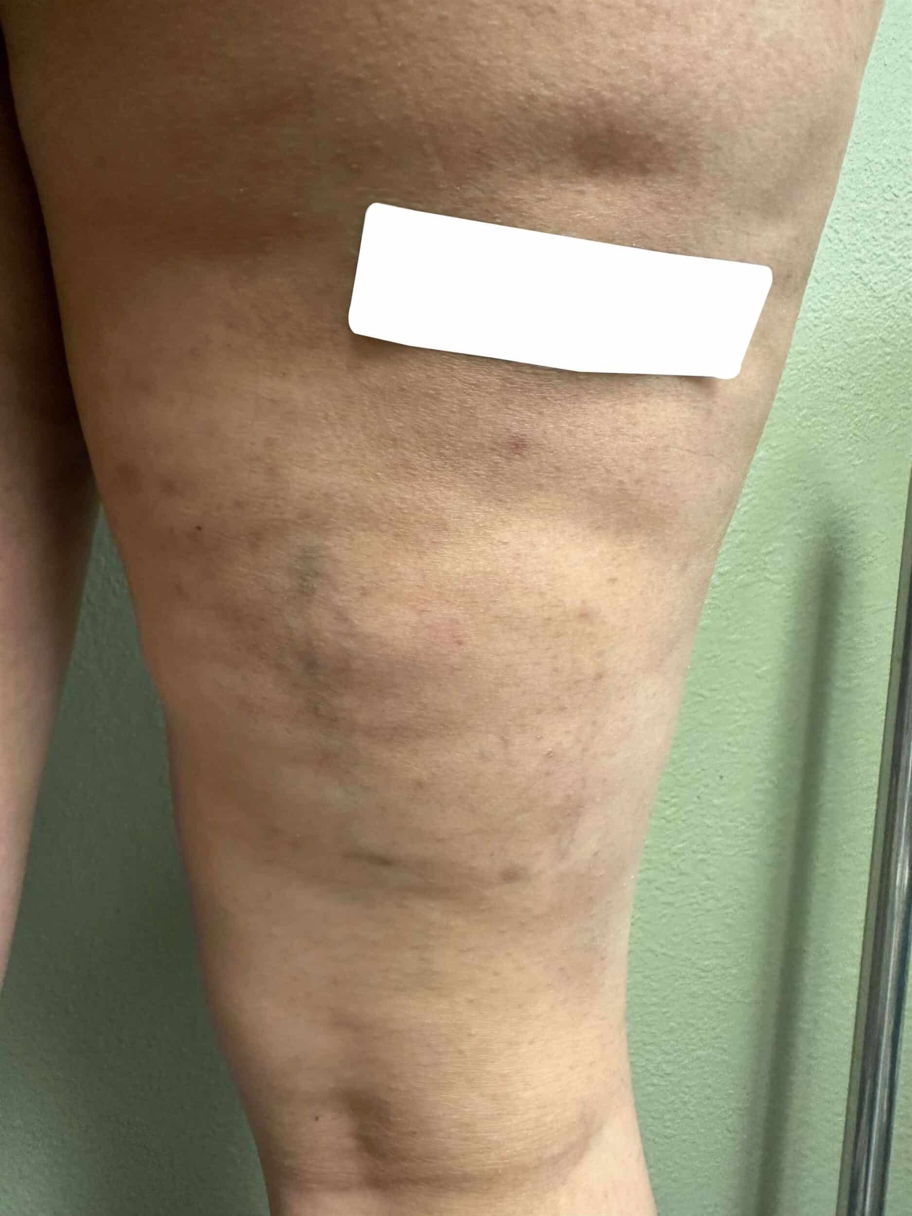 Before Image: Spider Veins - back