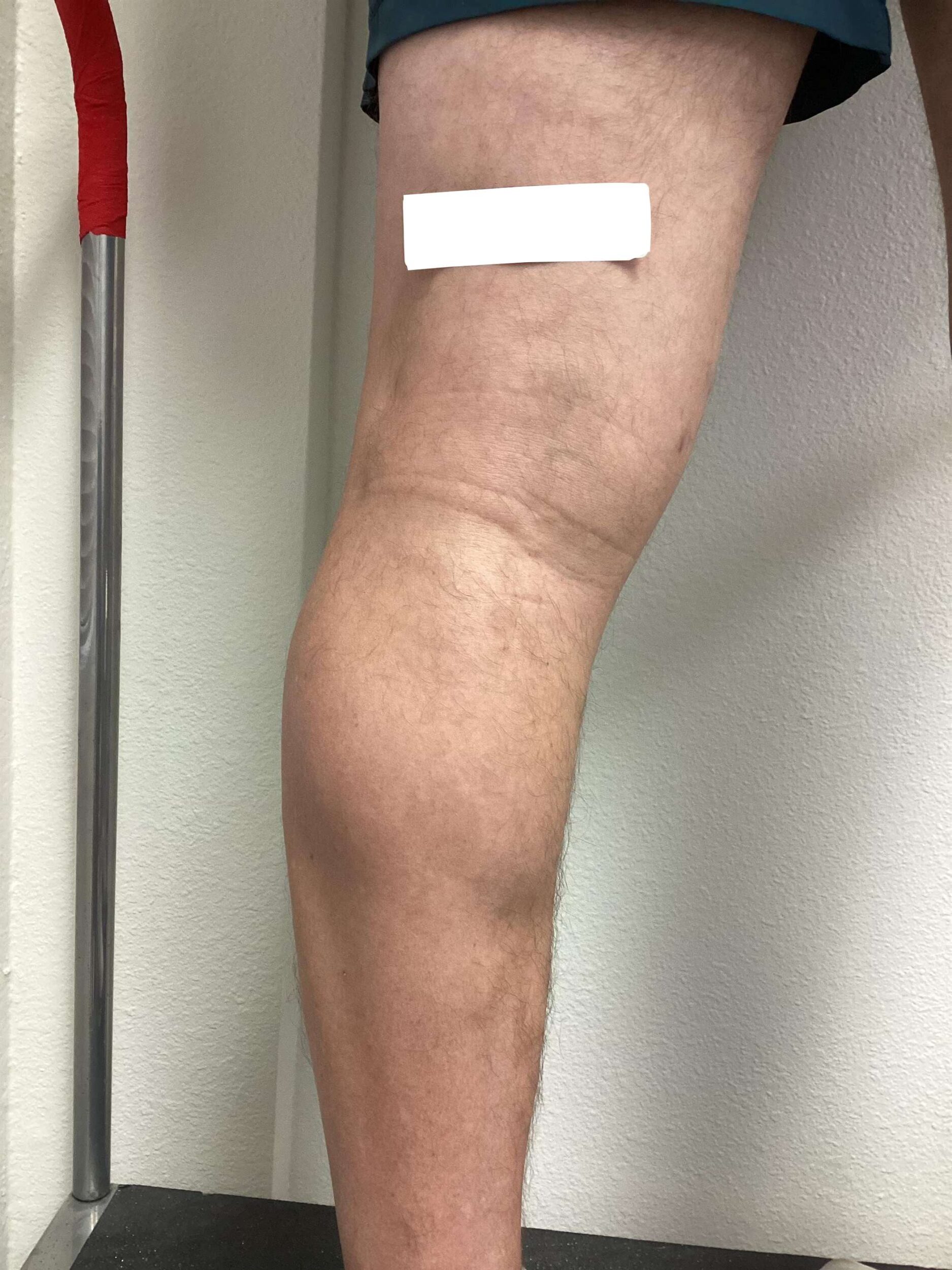 After Image: Varicose Veins - back