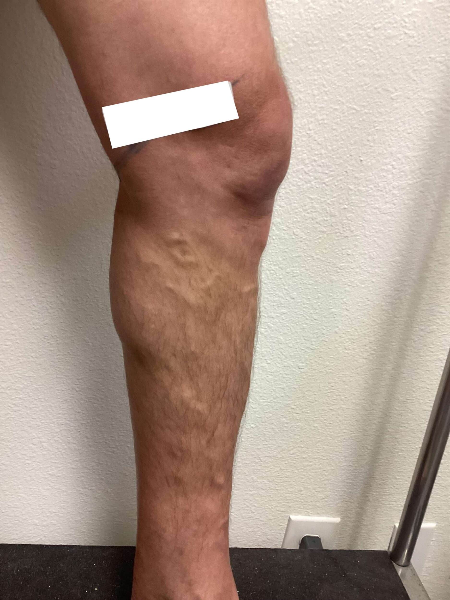Before Image: Varicose Veins - left-side