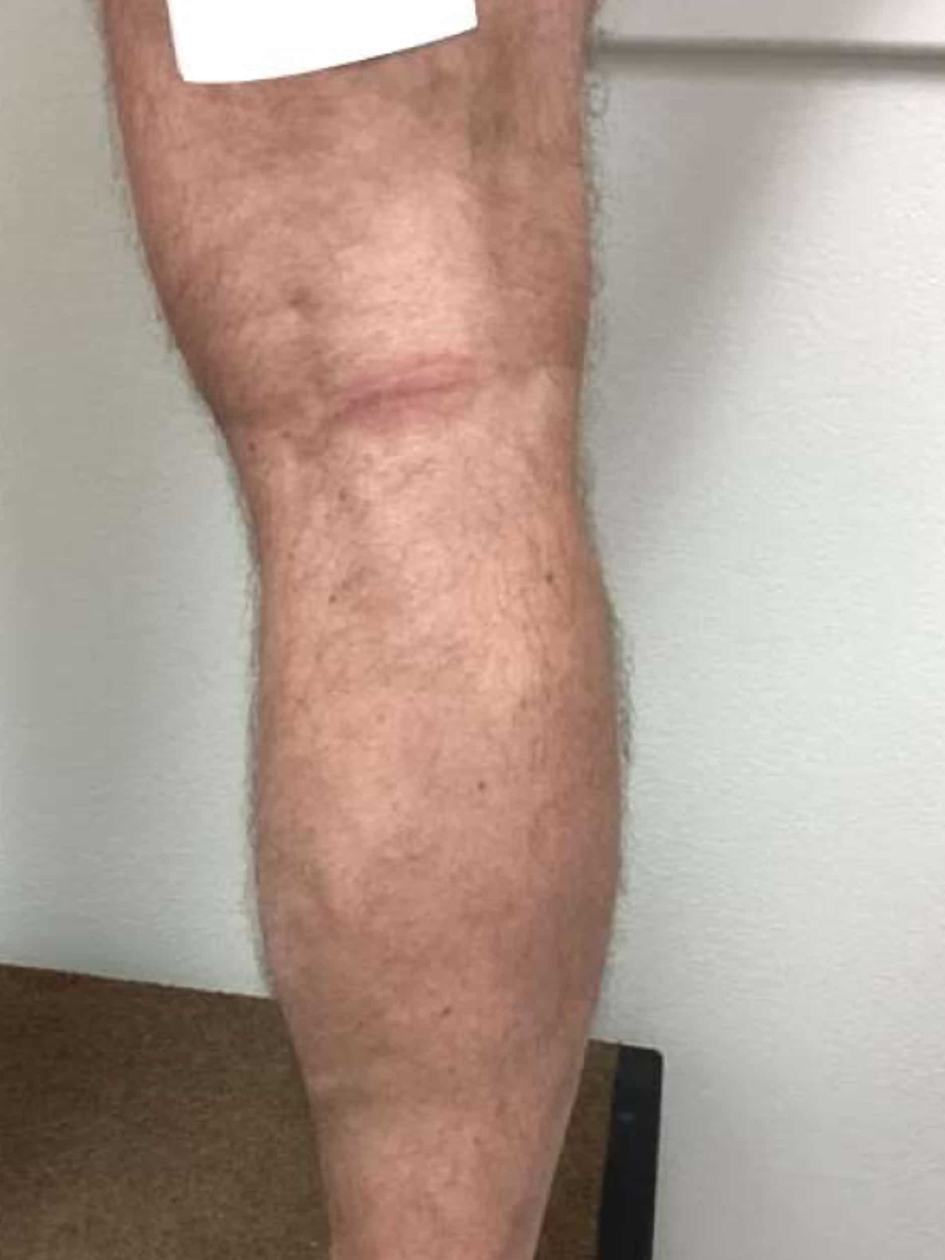 After Image: Varicose Veins - back