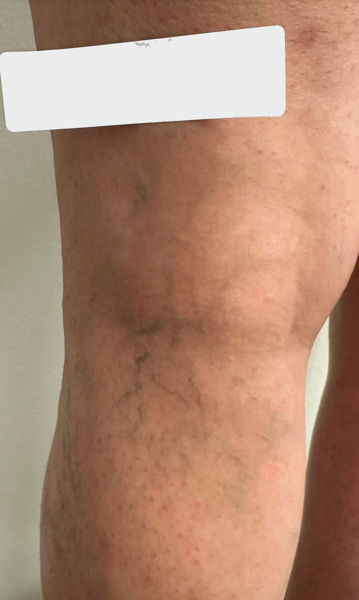 Before Image: Spider Veins - back