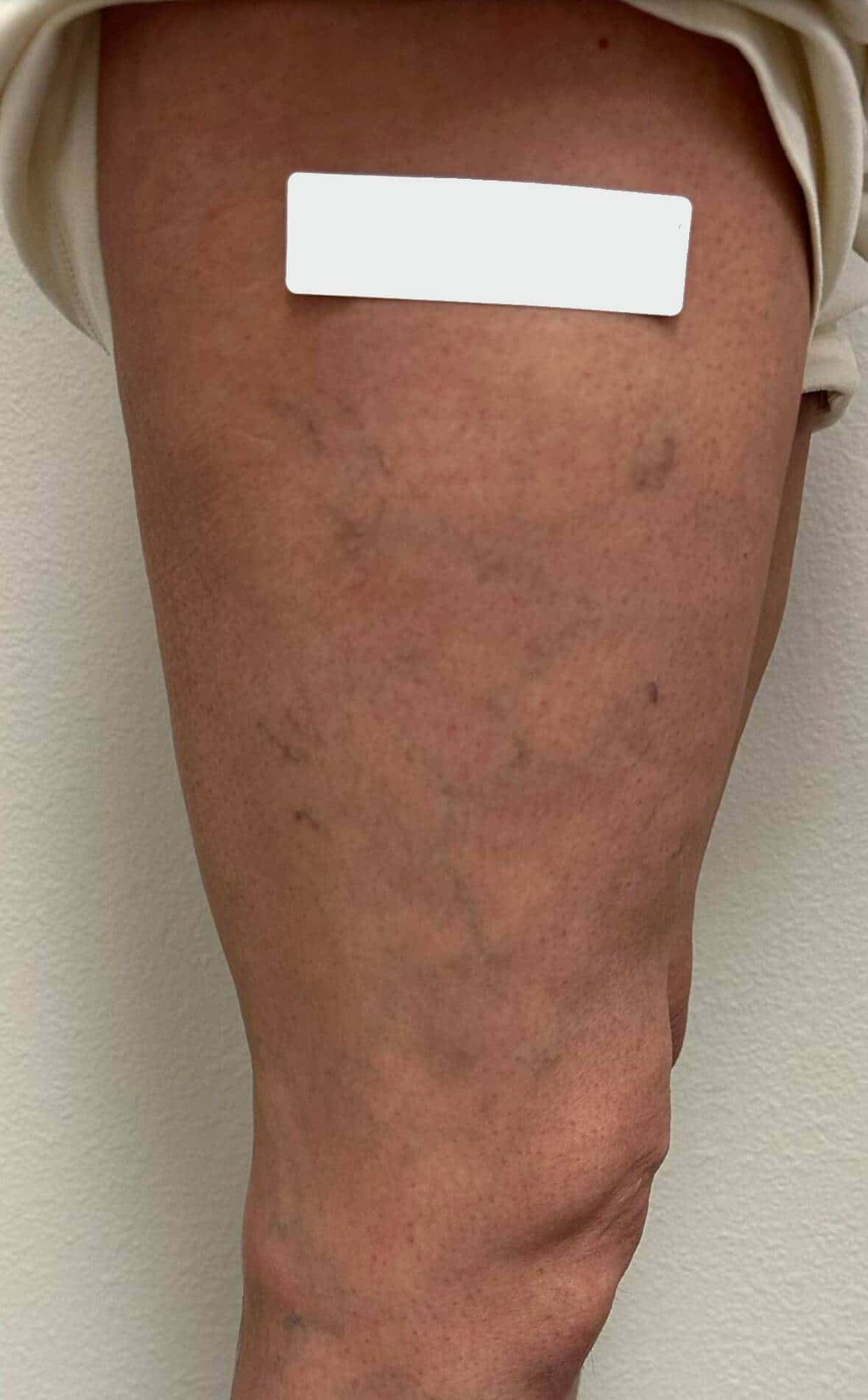 Before Image: Spider Veins - back