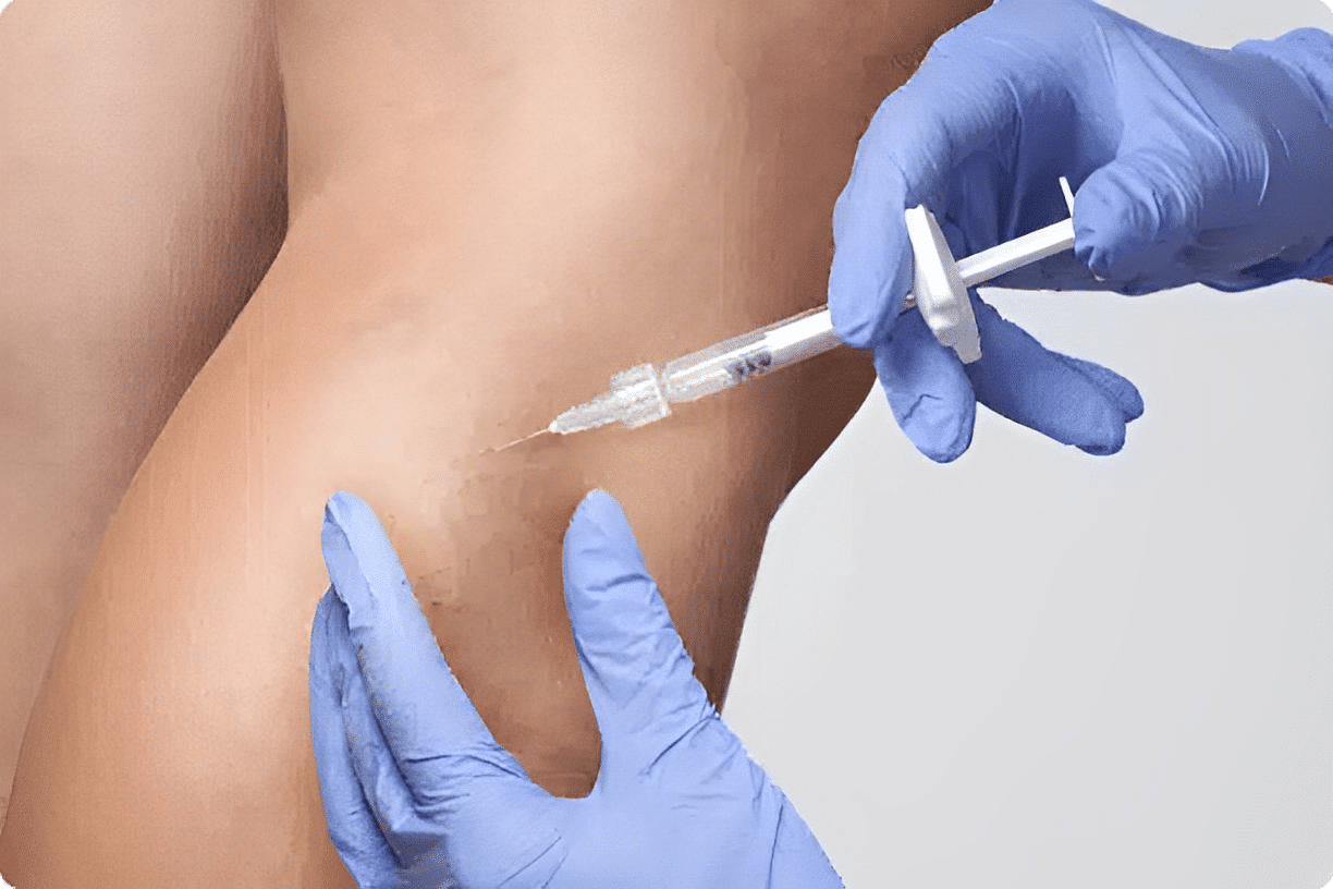 Surface Sclerotherapy Walnut Creek