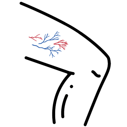 Spider Veins Treatment Oakland
